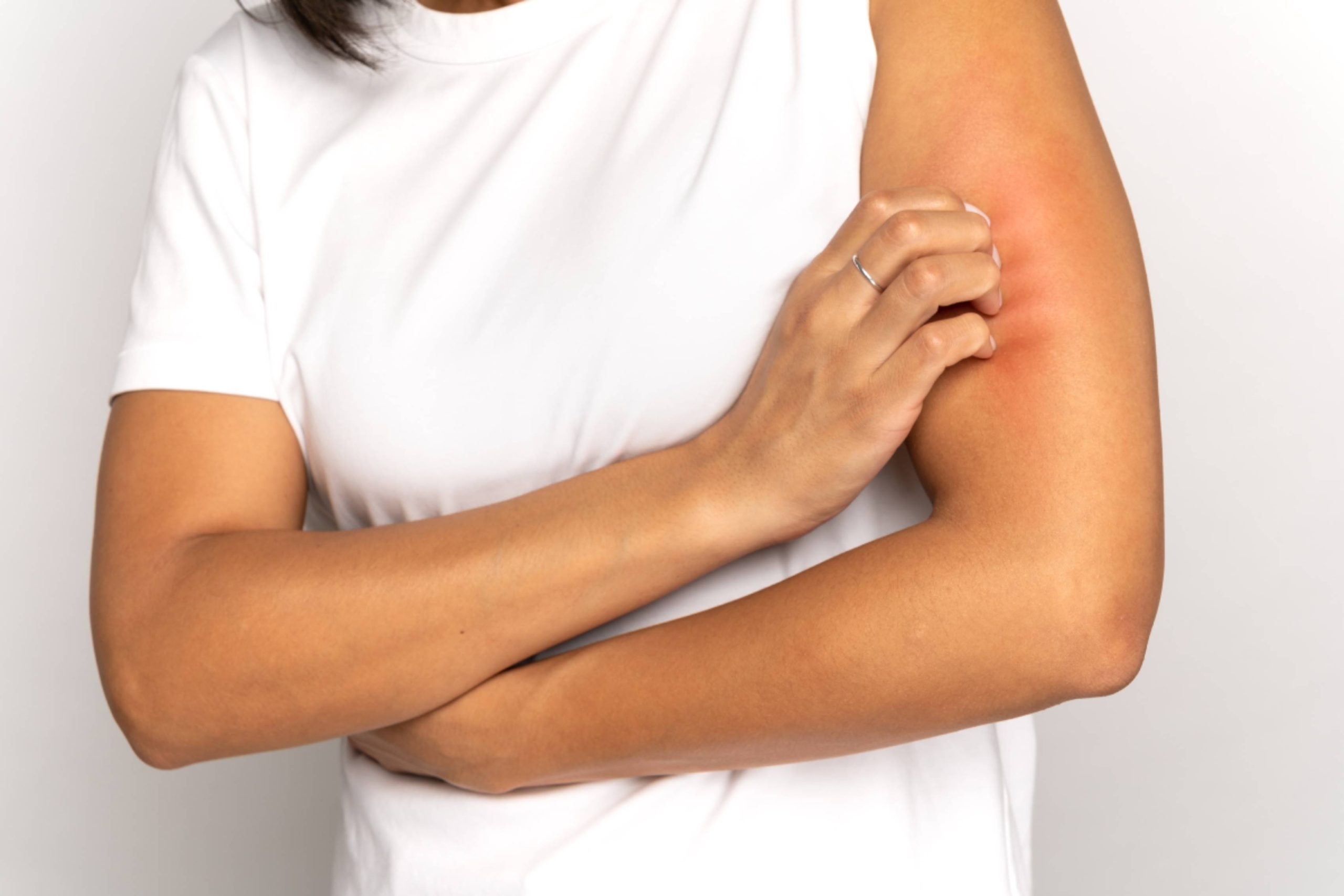girl-scratching-itch-on-hand-suffer-from-dry-skin-2025-03-08-19-23-26-utc (1)